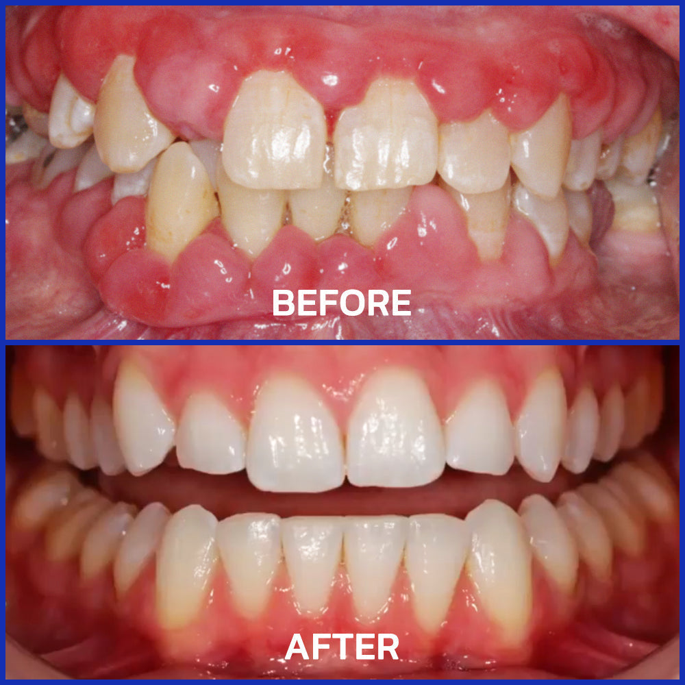 Furzero® Focussmile bee venom treatment powder for oral use🦷🇺🇸