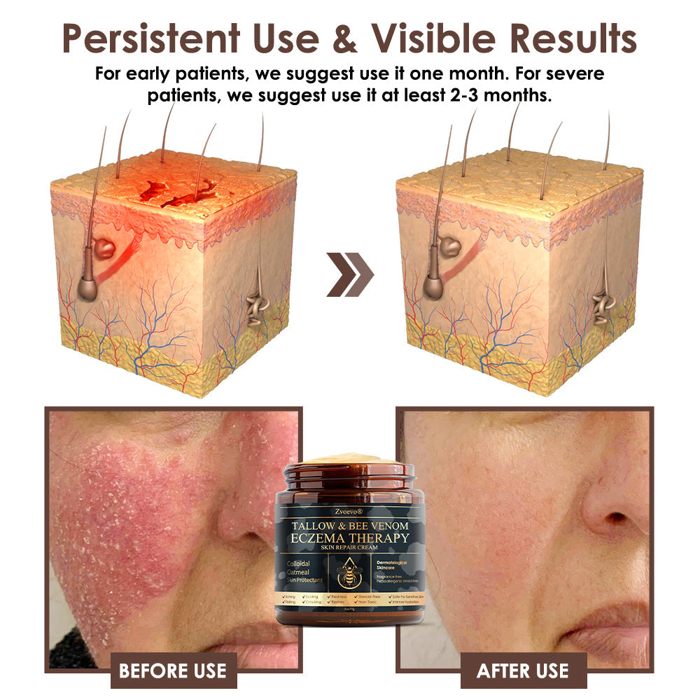 Zvoevo® Tallow Bee Venom Skin Restoration Cream (Made in USA🇺🇸)