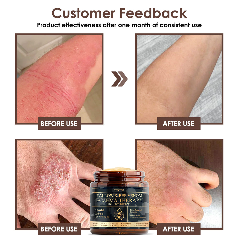 Zvoevo® Tallow Bee Venom Skin Restoration Cream (Made in USA🇺🇸)