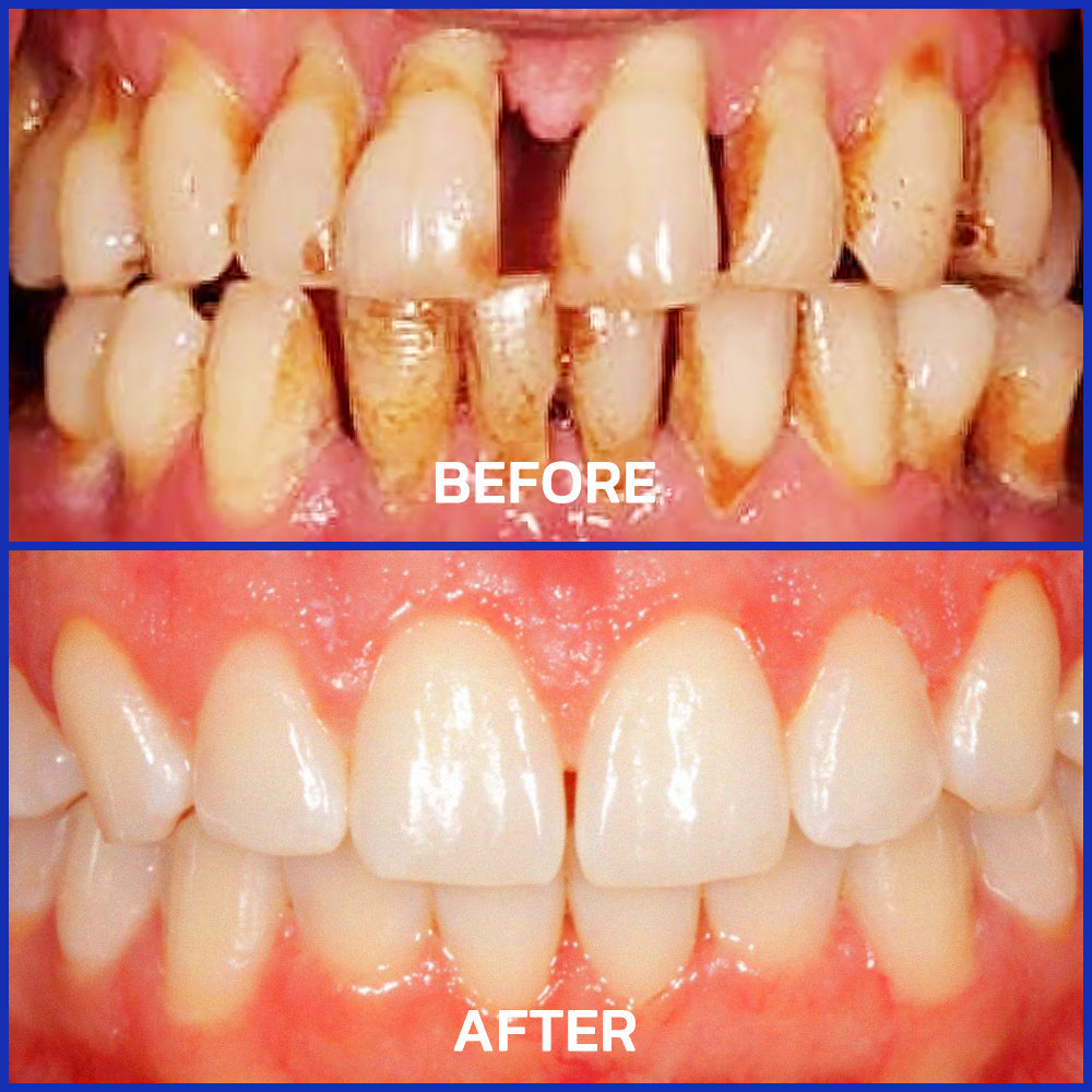 Furzero® Focussmile bee venom treatment powder for oral use🦷🇺🇸