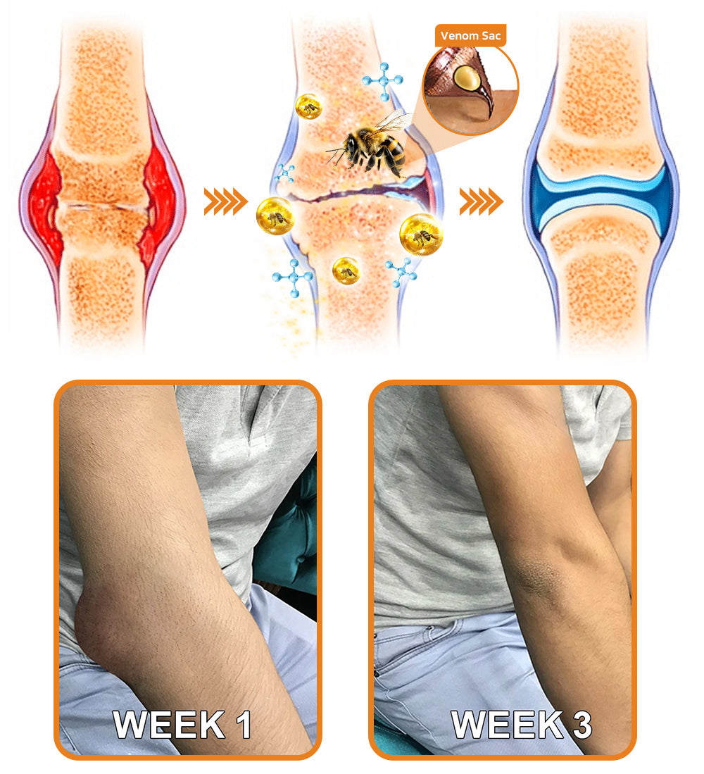 🇺🇸Official Store: flysmus™ Bee-Venom Pain-Relief Bone Healing Cream👨‍⚕️FDA Certified